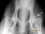 arthritic hip